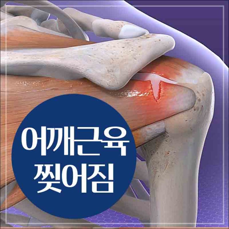 어깨 근육 찢어짐 회전근개 파열 염증과 손상 이유 : 네이버 블로그