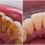광주 치과 국민건강보험 치과 치료 알아보기
