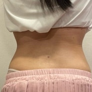 광주 지방흡입 복부 후기 (달라진 허리 라인 중점)
