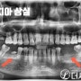 2동탄임플란트 다수의 치아를 상실했다면 임플란트로 기능 회복 가능