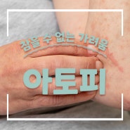 아토피와 함께하는 삶의 품질 향상을 위한 팁!