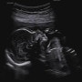 [임신 20주차] 정밀검사, 역아 / 강원도여행