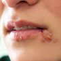 입술과 생식기 수포 생기는 헤르페스, 어떻게 예방할까?