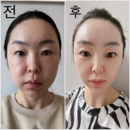 압구정역 피부과 볼뉴머&슈링크유니버스 일주일 전후 비교, 통증 후기!