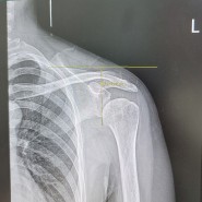 왼쪽 어깨 방카르트 수술후기 9주차