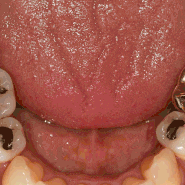 신흥역 치과에서 재신경치료하고 지르코니아 크라운 씌운 케이스
