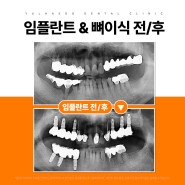 김해장유임플란트 뼈이식 기간 식사 고려할 점