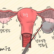 난소낭종 수술 후기 경화술 재발 없도록