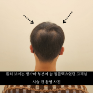 세종 두피 문신 - 탈모의 시작, 정수리 두피 문신으로 해결