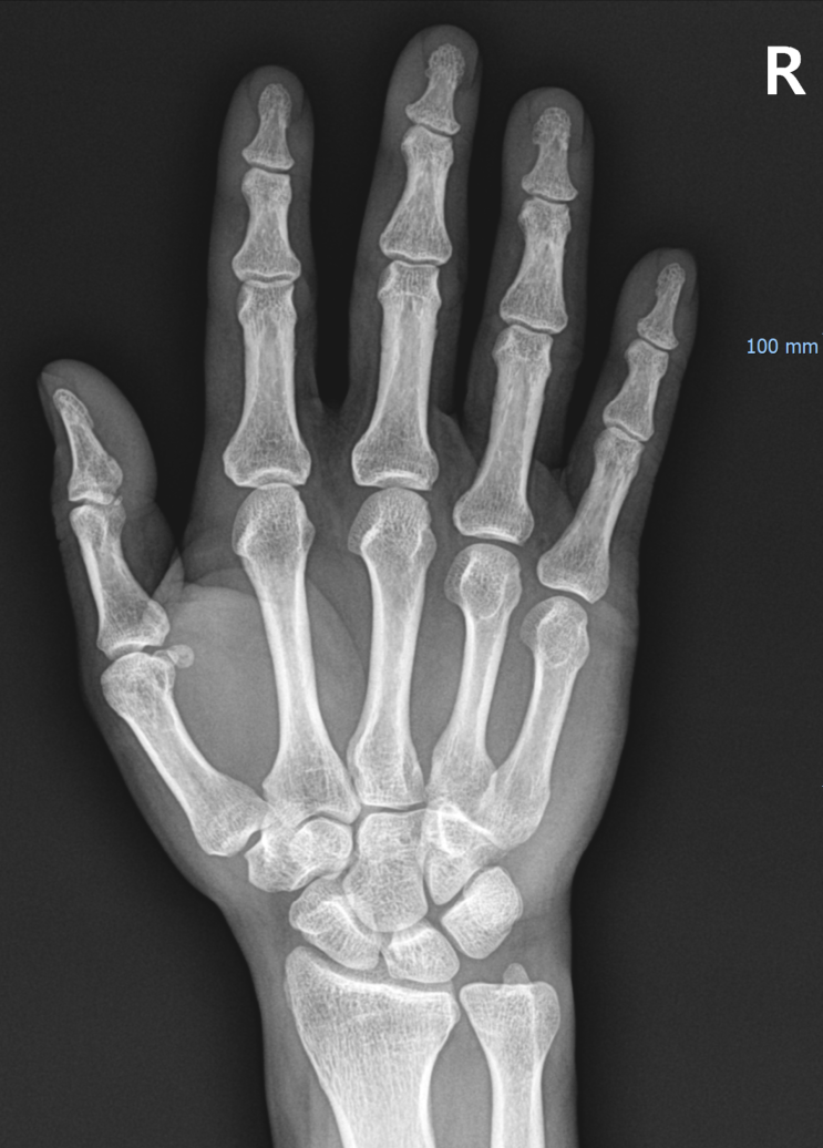 갈고리뼈 골절 (Hamate bone fracture) : 네이버 블로그