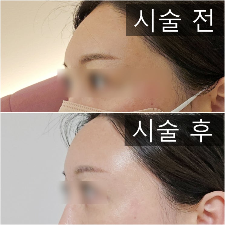 강남역 피부과 자연스러운 이마필러 멍, 통증, 붓기, 가격 내돈내산 : 네이버 블로그 강남역 피부과 자연스러운 이마필러 멍, 통증, 붓기, 가격 내돈내산 : 네이버 블로그
