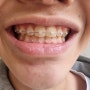 치아교정 끝났습니다. 1년 6개월간 3급 부정교합 치아교정기 과정 정리