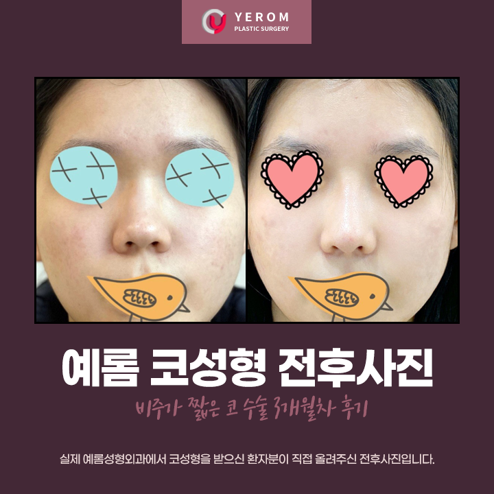 [짧은코성형] 비주가 짧은 코 수술 3개월차 후기 : 네이버 블로그