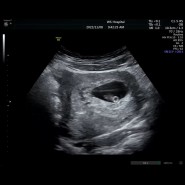 [임신9주] 임신9주 또 피비침 피고임 으로 병원 방문했어요