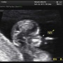 [12주] 초음파 1차 기형아 검사, 입체 초음파, 태아보험 들기(현대해상 태아보험)