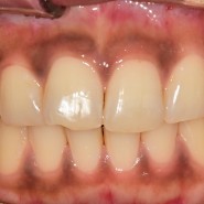 금광동 치과, 까맣게 보이는 잇몸을 미백으로 하얗게 만들기