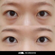 눈밑지방재배치 수술경과 및 한계점 ㅣ 신논현 눈밑지방재배치 수술후기