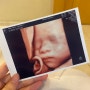 [임신기록] 27주 봄빛병원 입체초음파, 빈혈 진료