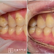 부천 치과 꼼꼼한 레진 치료. 마치 벽지 도배 작업과 같다?