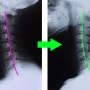 두통, 일자목, 거북목교정치료가 어려운 이유 - 일자목과 거북목 교정전후 케이스 엑스레이 비교