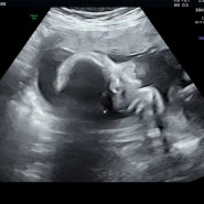[임신일기] 자궁무력증으로 23주에 입원