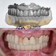 방이동 방이역치과, 풀아치임플란트 수술 1주일 후 임시치아까지 장착