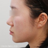 콧볼축소+비개방코끝성형후기 (코끝연골묶기, 귀연골이식)