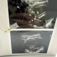 임신 중기 증상 4개월 15주차~24주차 태아 성별 입체초음파