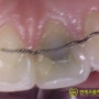 [정자동 치과] 신경치료한 치아가 검게 변했어요.(신경치료 후 변색, 실활치 미백)