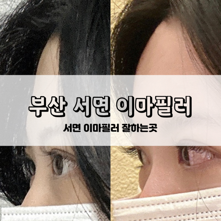 [서면] 부산 이마필러, 서면 이마필러 처음맞아본 솔직후기(전후차이/통증/붓기/시술시간/비교샷) : 네이버 블로그