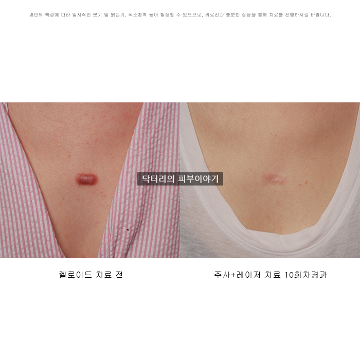 켈로이드 흉터 주사 + 레이저 치료 모두 해야 하는 이유 : 네이버 블로그