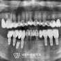 심한 치아우식 환자의 다수 임플란트 식립 증례!