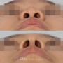 신사 콧볼축소수술 퍼져보이는 코끝 세련되게!균형잡힌 얼굴로