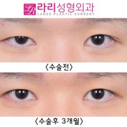 [라리성형외과] 각기 다른 양쪽의 짝눈교정 쌍꺼풀없애기 수술 전후 사진