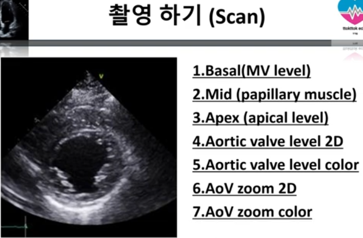 Echo PSAX(parasternal short axis view) 7개 view, (RVOT/RVIV/modified 4ch ...