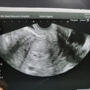 4주 임신확인, 임신초기 입덧증상 및 임신중기 컨디션, 32주 임신후기