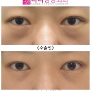 [라리성형외과] 뒤트임수술과 눈밑지방재배치 함께 하면 좋은 수술 best