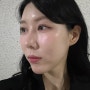 [선릉] 다크서클필러 맞고 5살은 어려진 내돈내산 후기 feat.필러염증