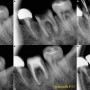 대구치 재근관치료 (Re-Endodontic treatment 5 years F/U)