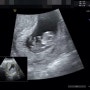또로 임신일기 💕 9주 - 10주 임산부 기록 ( 병원일기 🏥 )