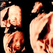 [베이비] 임신 29주차 (입체초음파)