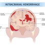 Intracerebral hemorrhage 대뇌출혈