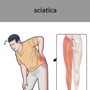 (목동재활PT) 좌골 신경통 (sciatica) 알아보기!