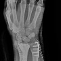 손목요골골절 수술 보험금 산정 제대로 하는 법
