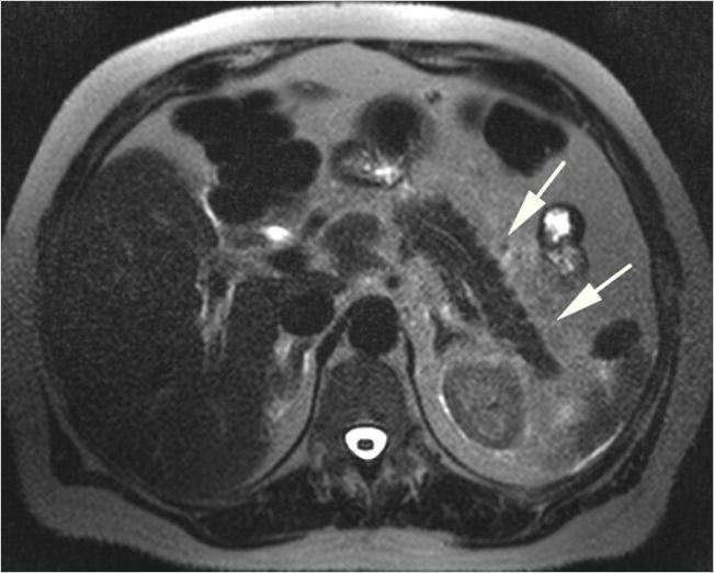 췌장암 검사 비용! CT, MRI 검사 방법 비교 : 네이버 블로그