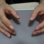 손가락 한마디 실리콘 의수 제작 사례