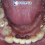 당산 치과 많은 어금니 상실 뼈이식 임플란트 식립 과정은 어떻게 진행되었을까?
