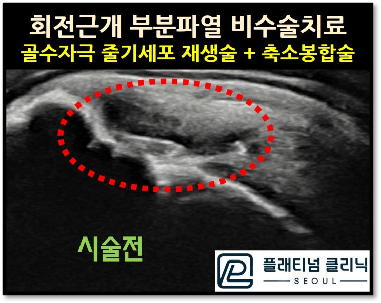 (강남어깨병원, 플래티넘의원) 회전근개 파열. 먼저 정확하게 진단하고 치료가 잘 안된다면 보다 적극적으로 치료해야 합니다.