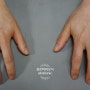 세번째 손가락 실리콘 의수 제작 사례