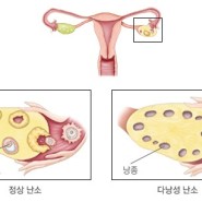 다낭성 난소 증후군, polycystic ovary syndrome